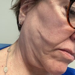 Cain Linville, MD, FACS - Scars on right side of face and "hanging" glands.