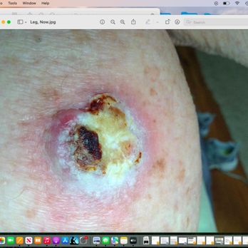 Affiliates in Dermatology - Squamous...after 7 months - Dermatologists Near Me - Oakland, California Affiliates in Dermatology - Squamous...after 7 months - Dermatologists Near Me - Oakland, California