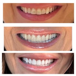 Summerlin Dental - Stages of veneer procedure.