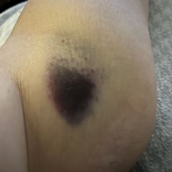 Quest Diagnostics - Third and most painful stick - with pain while moving arm - Laboratory Testing Near Me - Metairie, Louisiana