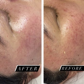 Virtue Holistic Skin Studio  - Before and After - Dermaplane + Organic Enzyme Peel. - Skin Care Near Me