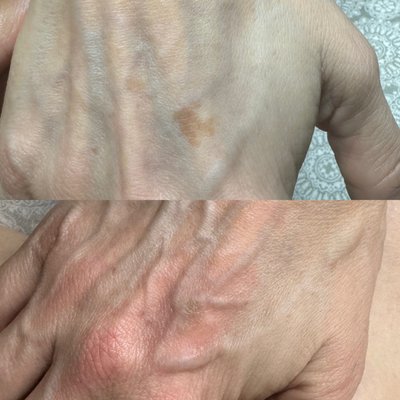 Thermoclear results - Conditions I can treat with low and high frequency: Small Spider Capillaries, Cherry Angiomas, Milia, Acne, Skin Tags, Sebaceous Hyperplasia, Cholesterol Deposits, Sun and Age Spots. This service can be a stand alone or an add-on to any service. Thermoclear results - Conditions I can treat with low and high frequency: Small Spider Capillaries, Cherry Angiomas, Milia, Acne, Skin Tags, Sebaceous Hyperplasia, Cholesterol Deposits, Sun and Age Spots. This service can be a stand alone or an add-on to any service.