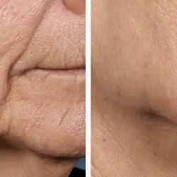 Perfect Skin Center - Ellacor scar-less face lift before after photo