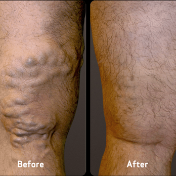 USA Vein Clinics - Vascular Medicine Near Me - Thousand Oaks, California USA Vein Clinics - Vascular Medicine Near Me - Thousand Oaks, California