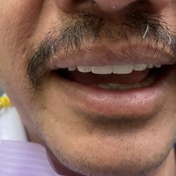 Family Dental of Palatine - After dental crowns