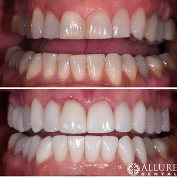 Allure Dental - Full mouth smile rejuvenation with a bite lift. Anti-aging dentistry by renowned cosmetic dentist Daniela Eversgerd - General Dentistry Near Me - Mandeville, Louisiana Allure Dental - Full mouth smile rejuvenation with a bite lift. Anti-aging dentistry by renowned cosmetic dentist Daniela Eversgerd - General Dentistry Near Me - Mandeville, Louisiana