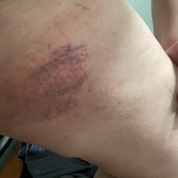 Browz Art - Bruise after wax.  The older lady repeatedly mentioned it would "go away" in 30 minutes.