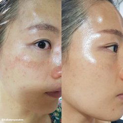 Before and After