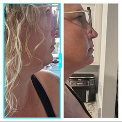 Cryotherapy of Charlotte County - Side profile, noticeable difference after the 1st session