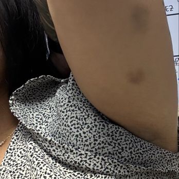 SoFi Stadium - Bruises from excessive force from security - Stadiums & Arenas Near Me - Inglewood, California