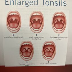 Mojgan Shokri, DDS - Mega Bite Dental - Enlarged Tonsils Informational Chart