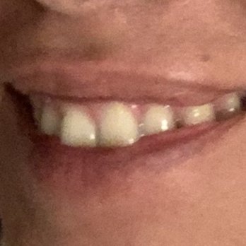 The Smile Lounge - Before - General Dentistry Near Me - West Hollywood, California
