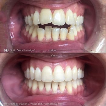 Stanton E Young, DMD - Invisalign ® by Dr. Stanton Young can improve significantly how teeth look and function. - Cosmetic Dentists Near Me - New York, New York Stanton E Young, DMD - Invisalign ® by Dr. Stanton Young can improve significantly how teeth look and function. - Cosmetic Dentists Near Me - New York, New York