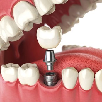 Keele Crosstown Dental - Dental Implants in York - General Dentistry Near Me - York, Ontario Keele Crosstown Dental - Dental Implants in York - General Dentistry Near Me - York, Ontario
