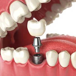 Keele Crosstown Dental - Dental Implants in York