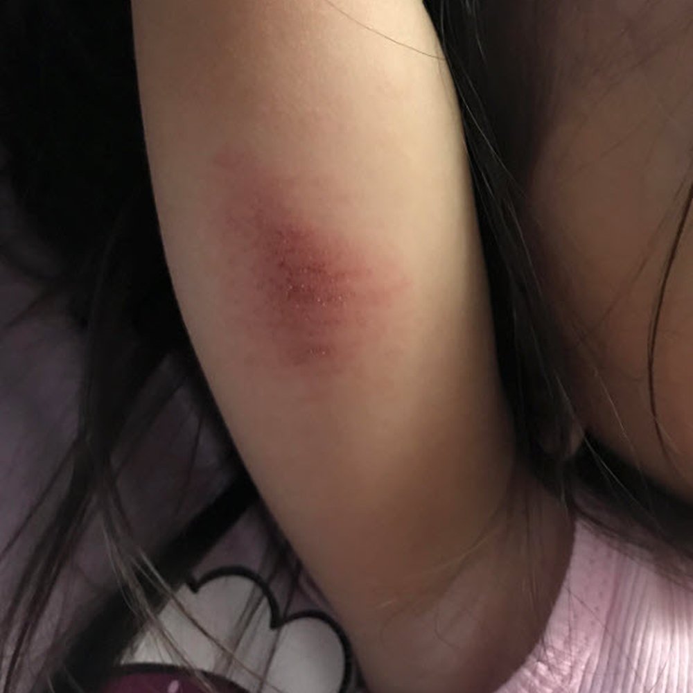 Montessori Children's House - Under arm bruise - Montessori Schools Near Me - Long Beach, California Montessori Children's House - Under arm bruise - Montessori Schools Near Me - Long Beach, California