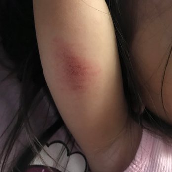 Montessori Children's House - Under arm bruise - Montessori Schools Near Me - Long Beach, California