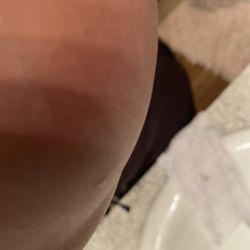 Budget Inn - More bed bug bites on my arms