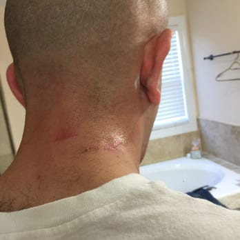 Hair Cuttery Color & Haircuts - Lombard - Very bad hair cut outcome with infection of skin due to skin cut - Hair Stylists Near Me - Lombard, Illinois