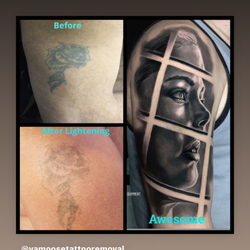Removery Tattoo Removal & Fading