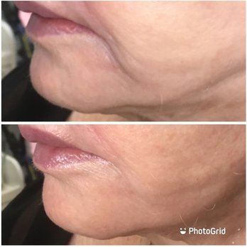 Rose Dermatology - Before and after skin tightening with the Titan laser - Dermatologists Near Me - Astoria, New York
