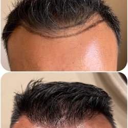 La Mesa Medical Hair Restoration - 6 mos post op