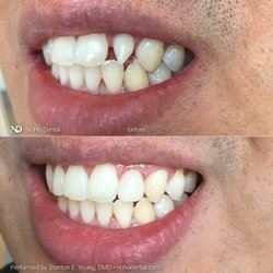 Stanton E Young, DMD - Dental bonding by Dr. Stanton Young
