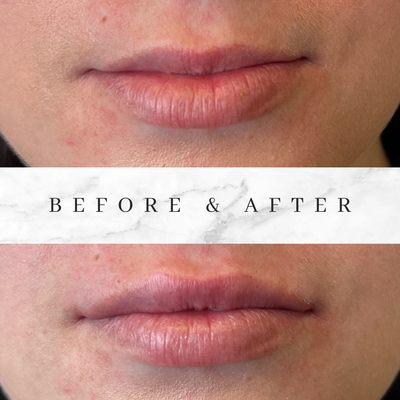 Dermal filler for lips - Dermal filler, RHA was used for the lips to enhance their natural beauty, and then redensity was used to smooth out the lipstick lines on the second photo