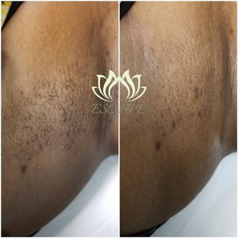 Escape Massage & Esthetics Studio - Waxing Results - Massage Therapy Near Me - Manchester, Connecticut Escape Massage & Esthetics Studio - Waxing Results - Massage Therapy Near Me - Manchester, Connecticut