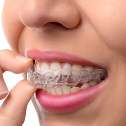 Top Smile Orthodontics - SUNNYVALE - We offer Invisalign®!