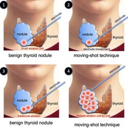 DECON - Diabetes & Endocrine Center of Nevada - Get Rid of Benign Thyroid Nodules without surgery and scar at DECON!