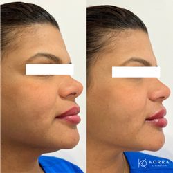 Korra Aesthetics - Lip Filler Before And Immediately After The Treatment
