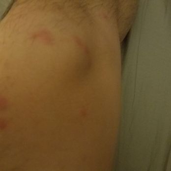 Sequoia Motel In Three Rivers - Bedbug bites from the Good Old River Inn and Cabins (a few of ~50 total) - Hotels Near Me - Three Rivers, California Sequoia Motel In Three Rivers - Bedbug bites from the Good Old River Inn and Cabins (a few of ~50 total) - Hotels Near Me - Three Rivers, California