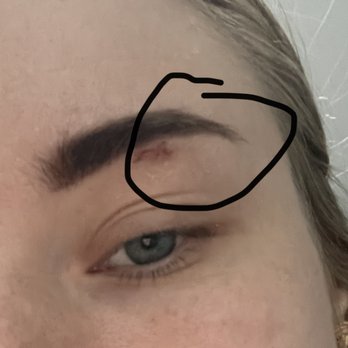 Di Sole Beauty Studio - The wound that was right after the procedure ( because the technician did eyebrows for 9 hours ) - Permanent Makeup Near Me - Brooklyn, New York Di Sole Beauty Studio - The wound that was right after the procedure ( because the technician did eyebrows for 9 hours ) - Permanent Makeup Near Me - Brooklyn, New York
