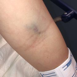 Greer Medical Campus - Arm after IV