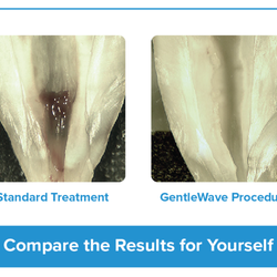 North Sound Root Canal Specialists - The GentleWave® gives you a cleaner clean and leaves more of your natural tooth structure intact.