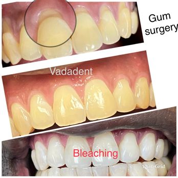 Vadadent Modern Dental Group - Whitening and gum surgery - Cosmetic Dentists Near Me - Lawndale, California Vadadent Modern Dental Group - Whitening and gum surgery - Cosmetic Dentists Near Me - Lawndale, California