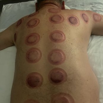 King Day Spa - Chinese Cupping Therapy - Massage Near Me - Sun City, Arizona King Day Spa - Chinese Cupping Therapy - Massage Near Me - Sun City, Arizona