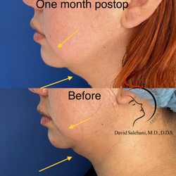 Sunset Oral and Facial Surgery - Submental fat (double chin) liposuction and radiofrequency skin tightening