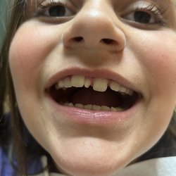 Lila Wilson, DDS - The extra tooth that was removed without any pain