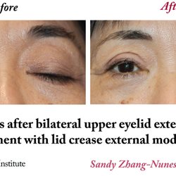 USC Roski Eye Institute- Oculo-Facial Plastic Surgery Service - Bilateral upper eyelid external levator advancement with lid crease external modification.