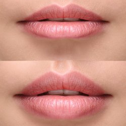 MedSpa California - Lips Enhancement -Medspa Patient