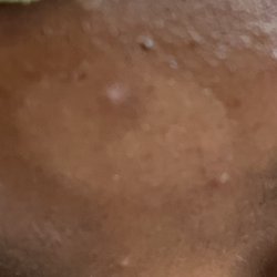 Heavenly Spa & Salon - Her forehead with her skin completely burned