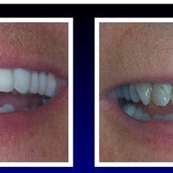 Watson Pointe Dental: Joseph S. Grimaud, DDS - After/Before cosmetic treatment.