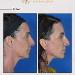 Visage Facial Plastic Surgery - Before/After Mini Lift by Dr. Patel