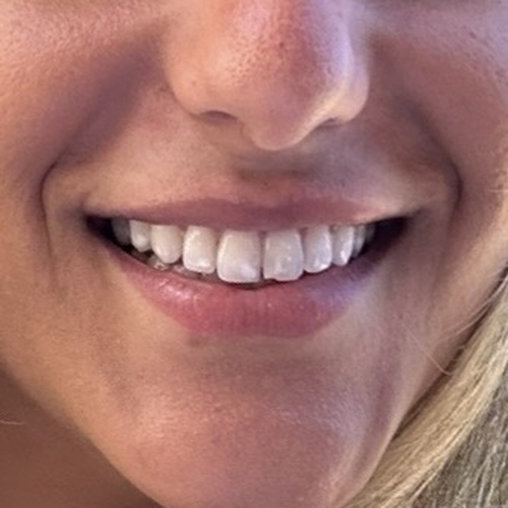 Chipped tooth before Chipped tooth before