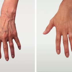 Boston Vein Care - Hand Veins Before and After 4 Treatments
