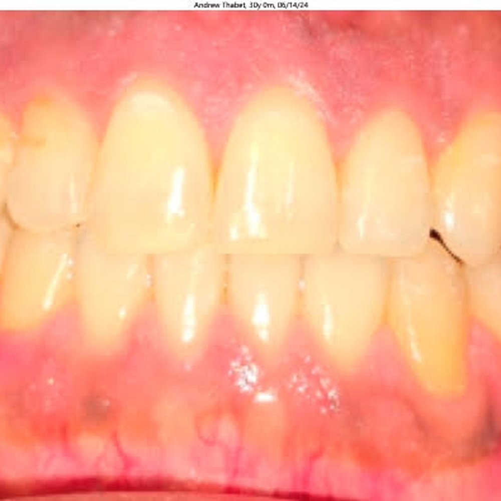 Studio City Orthodontist - Treatment Completed - Orthodontists Near Me - Studio City, California Studio City Orthodontist - Treatment Completed - Orthodontists Near Me - Studio City, California