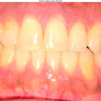 Studio City Orthodontist - Treatment Completed - Orthodontists Near Me - Studio City, California