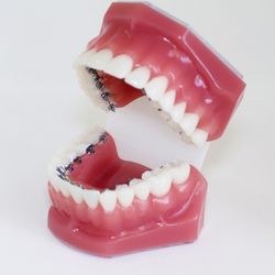 Team Orthodontics - So discreet you'll forget they are even there! Find out more about lingual braces and schedule your FREE consultation today! (480)759-3333